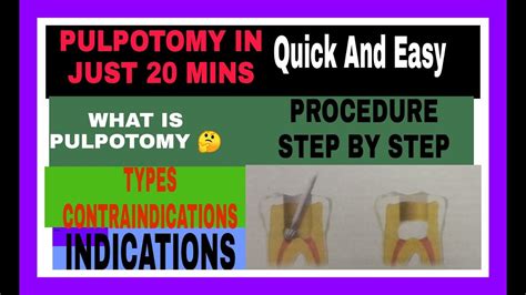 Pulpotomy Pedodontics|Types Of Pulpotomy|Indications ...