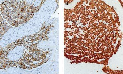 Immunohistochemical Stain Of The Tumour A Staining For Chromogranin