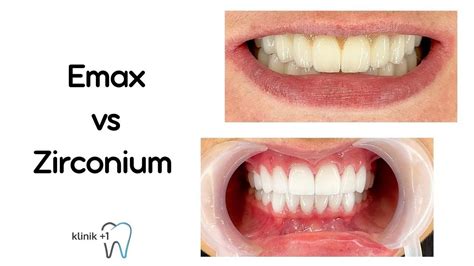 Emax Crowns