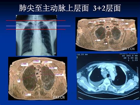 胸部ct阅片word文档在线阅读与下载无忧文档