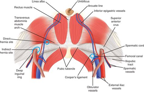 Inguinal Hernias Basicmedical Key