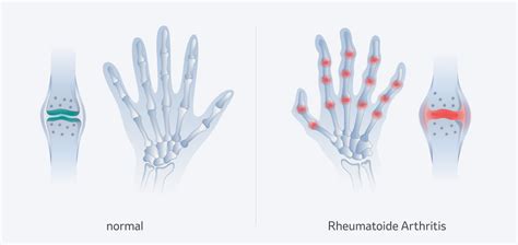 Rheumatoide Arthritis Definition Msd Gesundheit Schweiz