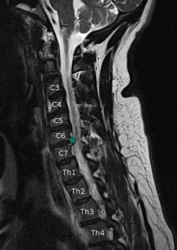 Cervical Myelopathy Flashcards Quizlet