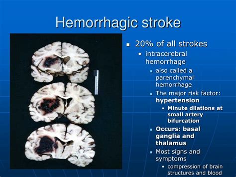 Ppt Cvd Stroke Septemius A Pansacola Rnmd Powerpoint Presentation