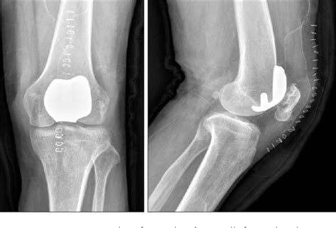 Figure 1 from Patellofemoral Osteoarthritis | Semantic Scholar