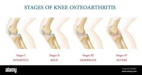 Medical infographics. Knee joint osteoarthritis stages, vector chart of ...