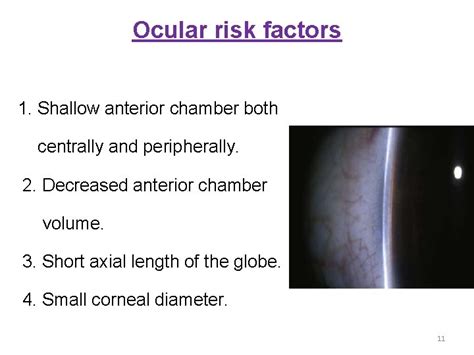 Primary Angle Closure Glaucoma Dr Ajai Agrawal Additional