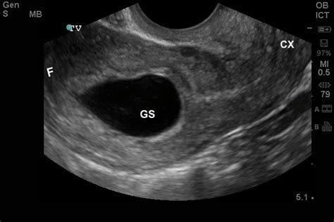 Scanning School Early Pregnancy Taming The Sru