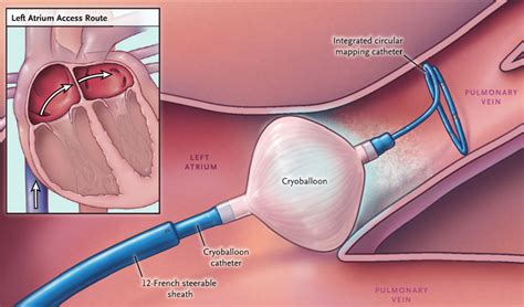 Atrial Fibrillation Dr Mark Walsh