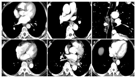 Low Dose Spectral Insufflation Computed Tomography Protocol