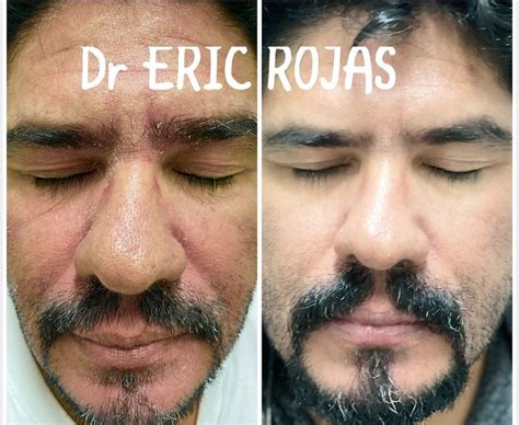 DERMATITIS SEBORREICA NOSOTROS LA MEJORAMOS DR ERIC ROJA Dr Eric