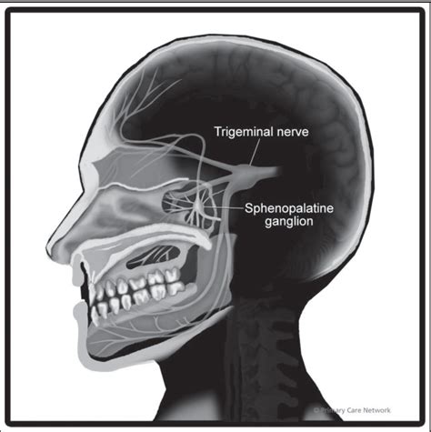 Sphenopalatine Ganglion Block Specialist