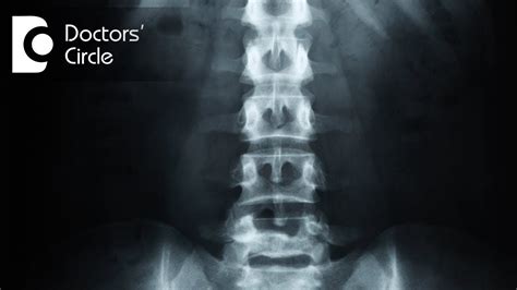 What Is Disc Desiccation Definition - mapasgmaes