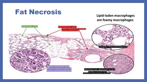 Difference Between Apoptosis Versus Necrosis And Types Of Necrosispptx