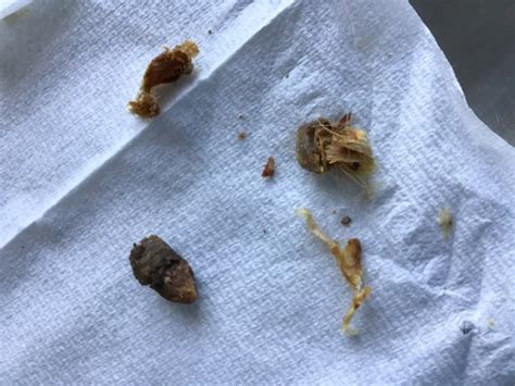 Watch The Satisfying Moment An Audiologist Removes A Gram Of Ear Wax