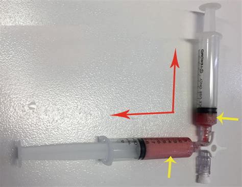 Agitated Salinebubble Study For The Detection Of An Intrapulmonary Or