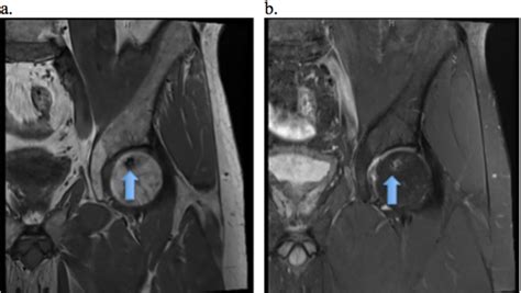 Typical Mri Appearance Of Avascular Necrosis In The Hip A T Coronal