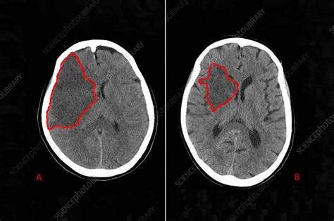 Brain Stroke, CT Scan - Stock Image - C027/2375 - Science Photo Library