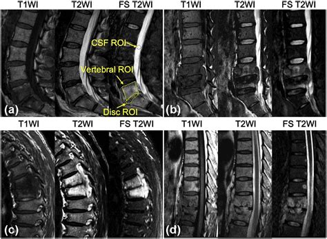 Differentiation Between Brucellar And Tuberculous Spondylodiscitis In