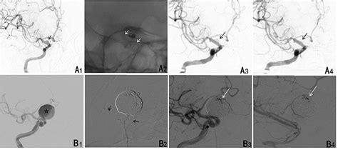 Frontiers Pipeline Embolization Device For The Treatment Of Ruptured