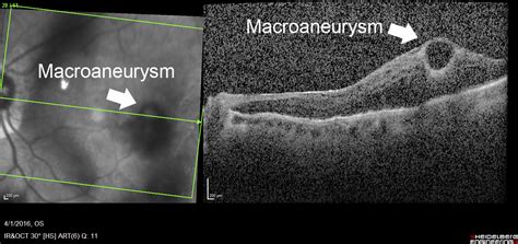 Retinal Arteriolar Macroaneurysm Scott E Pautler Md Tampascott E Pautler Md Tampa