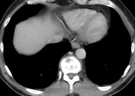 Imaging In Metastatic Renal Cell Carcinoma Ajr