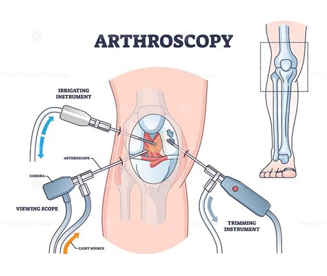 Arthroscopy Procedure As Knee Diagnostics Process Explanation Outline