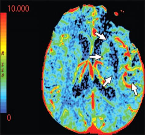 Imaging Of Stroke Part Perfusion Ct Overview Of Imaging Technique