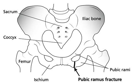 Pubic Ramus Bone Fracture