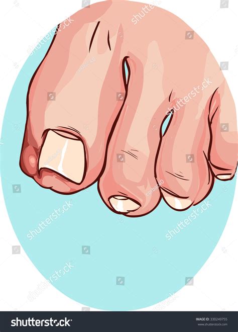 Ingrown Toenail Stock Vector Royalty Free 330249755 Shutterstock