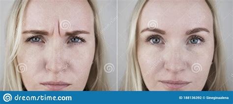 Foto Prima E Dopo Iniezioni Di Mesoterapia E Di Biorevitalizzazione