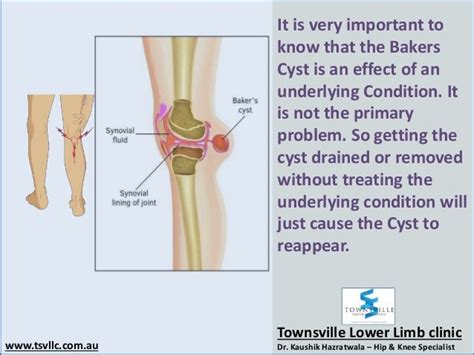 Bakers Cyst of The Knee