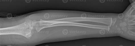 Broken arm xray 6519116 Stock Photo at Vecteezy