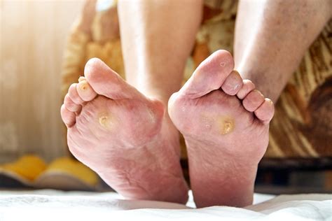 Diabetic Foot Assessment Sally Pembery Associates