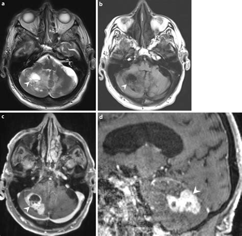 Axial T2 Weighted Images A Showed A Space Occupying Lesion Download Scientific Diagram