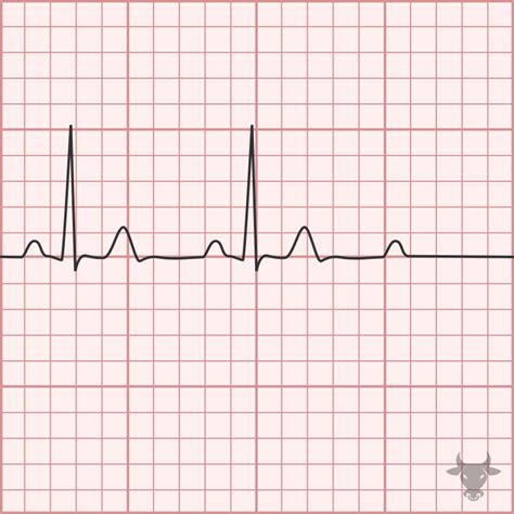 Second Degree Atrioventricular Block – Mobitz II | ECG Stampede