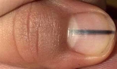 Skin Cancer Symptom Melanoma Sign Could Be Dark Stripe On Nail