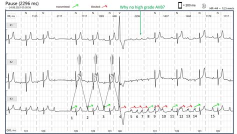 Blocked PACs | ECG Guru - Instructor Resources