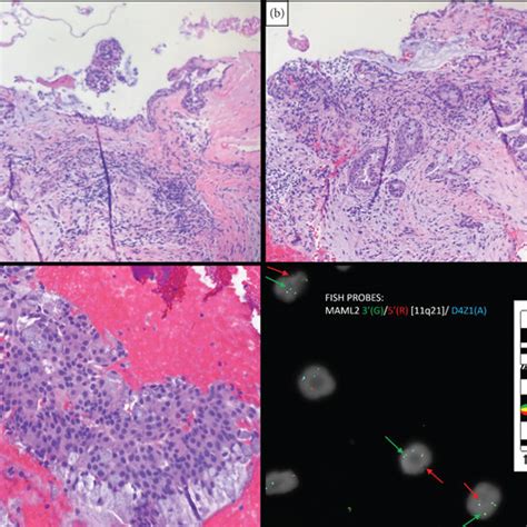 Maml2 Rearranged Central Mucoepidermoid Carcinoma Reported In The Download Scientific Diagram