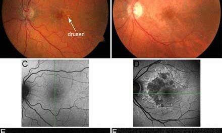 Por Qu Se Produce La Degeneraci N Macular Asociaci N M Cula Retina