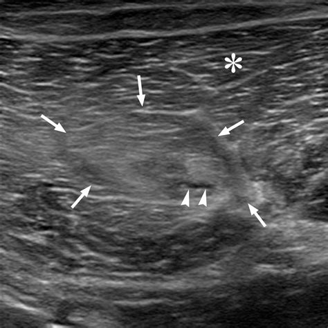 Imaging Of Muscle Injuries In Sports Medicine Sports Imaging Series Radiology