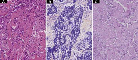 Figure3 Histological Findings Of Transbronchial Lung Biopsy Specimens