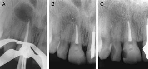 Nonsurgical Root Canal Therapy Of Large Cyst Like Inflammatory