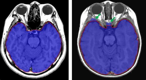 Estimation Of Intracranial Volume A Comparative Study Between