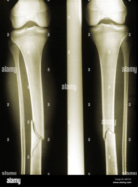 Fractured Tibia Stock Photo Alamy