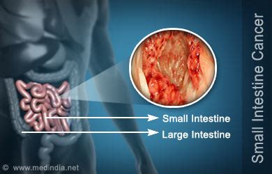 Cancer: Small Intestine Cancer