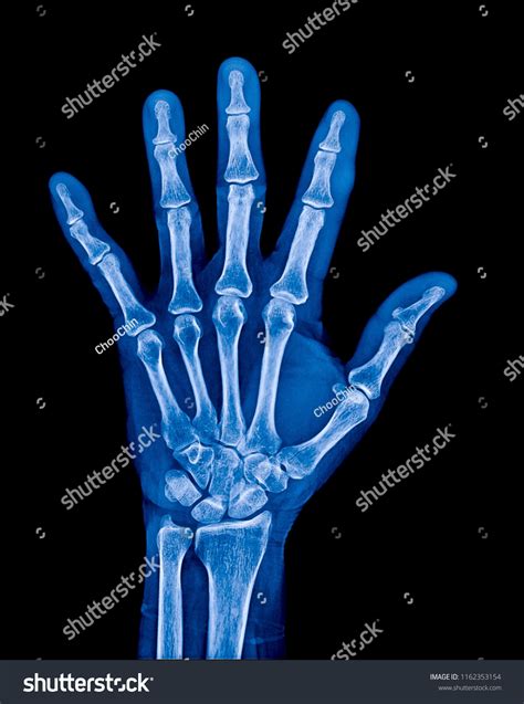 X Ray Hand Normal