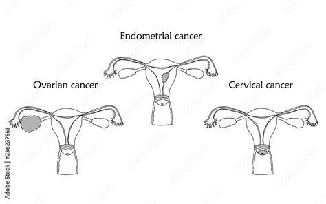 Ovarian Endometrial And Cervical Cancer Human Realistic Uterus