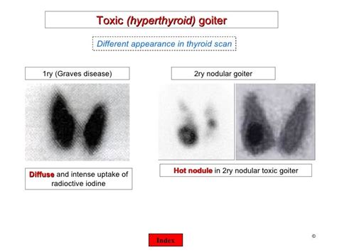 What Is A Thyroid Uptake And Scan Test