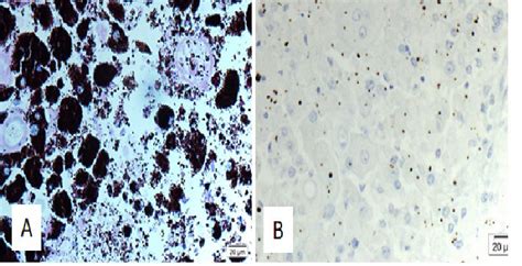 (A) Histology shows that the tissue of the iris is infiltrated by large ...